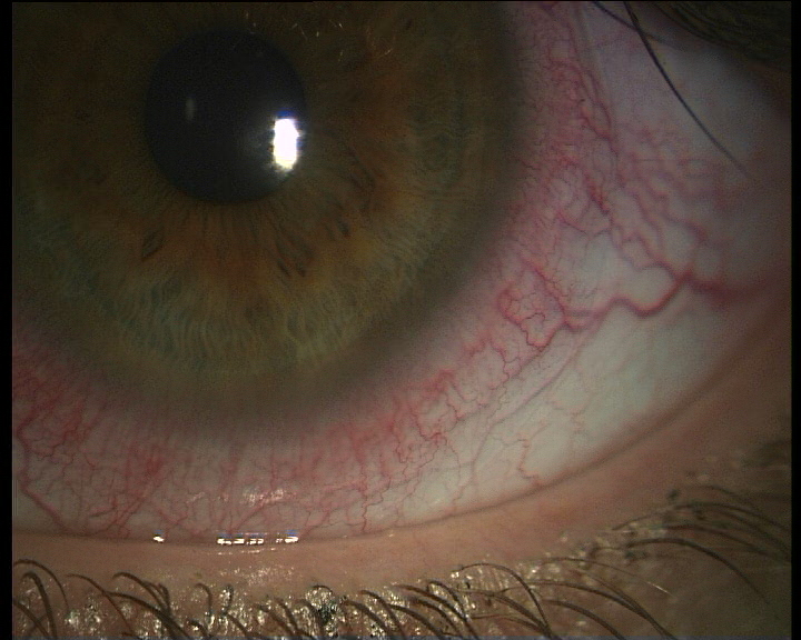 Nouveaux vaisseaux sanguins dans l'oeil à cause des lentilles de contact